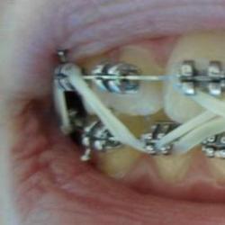 Gummibänder für Zahnspangen helfen bei der schnellen Korrektur von Defekten. Gummibänder für Zähne bei der Behandlung mit Zahnspangen