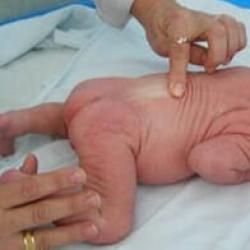 Apgar-Skala zur Beurteilung des Gesundheitszustands eines Neugeborenen